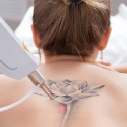 treatment on back tatoo