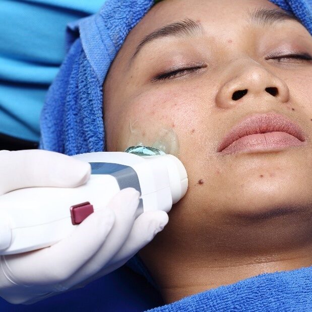 asian woman with blue hairnet receiving High Intensity Focused Ultrasound (HIFU) treatment