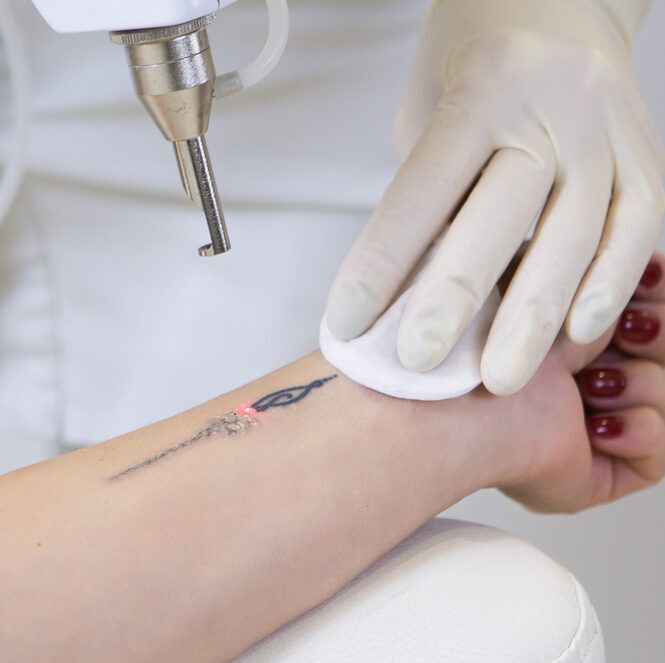 person receives laser tattoo removal treatment on wrist